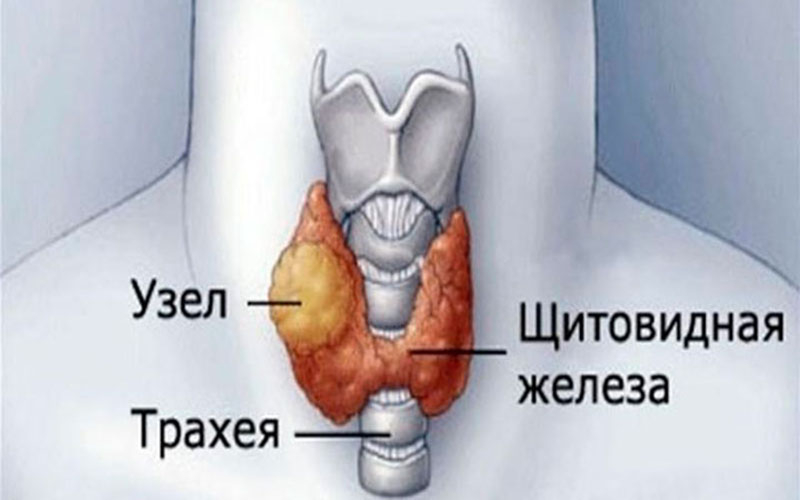 узлы на щитовидной железе чем опасны